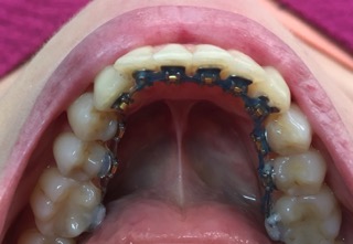 Ortodontia Lingual ortodontia-lingual-2
