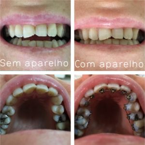 Ortodontia Lingual ortodontia-lingual