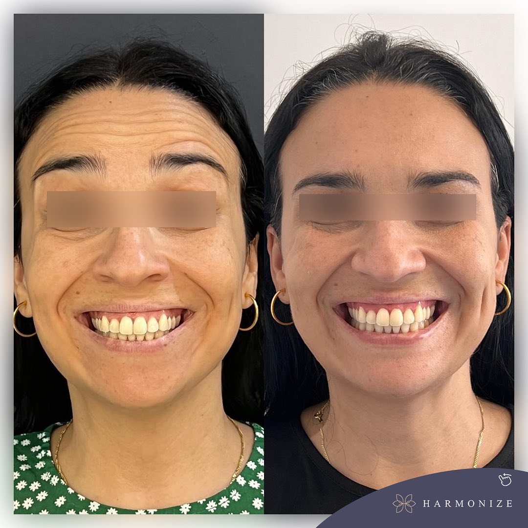 Dra. Juliana Fontes Botox #1.1