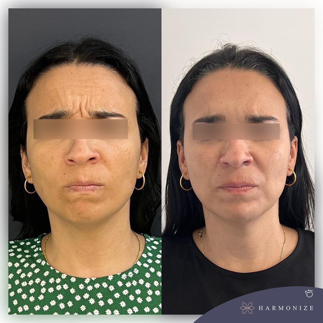 Dra. Juliana Fontes Botox #1.2