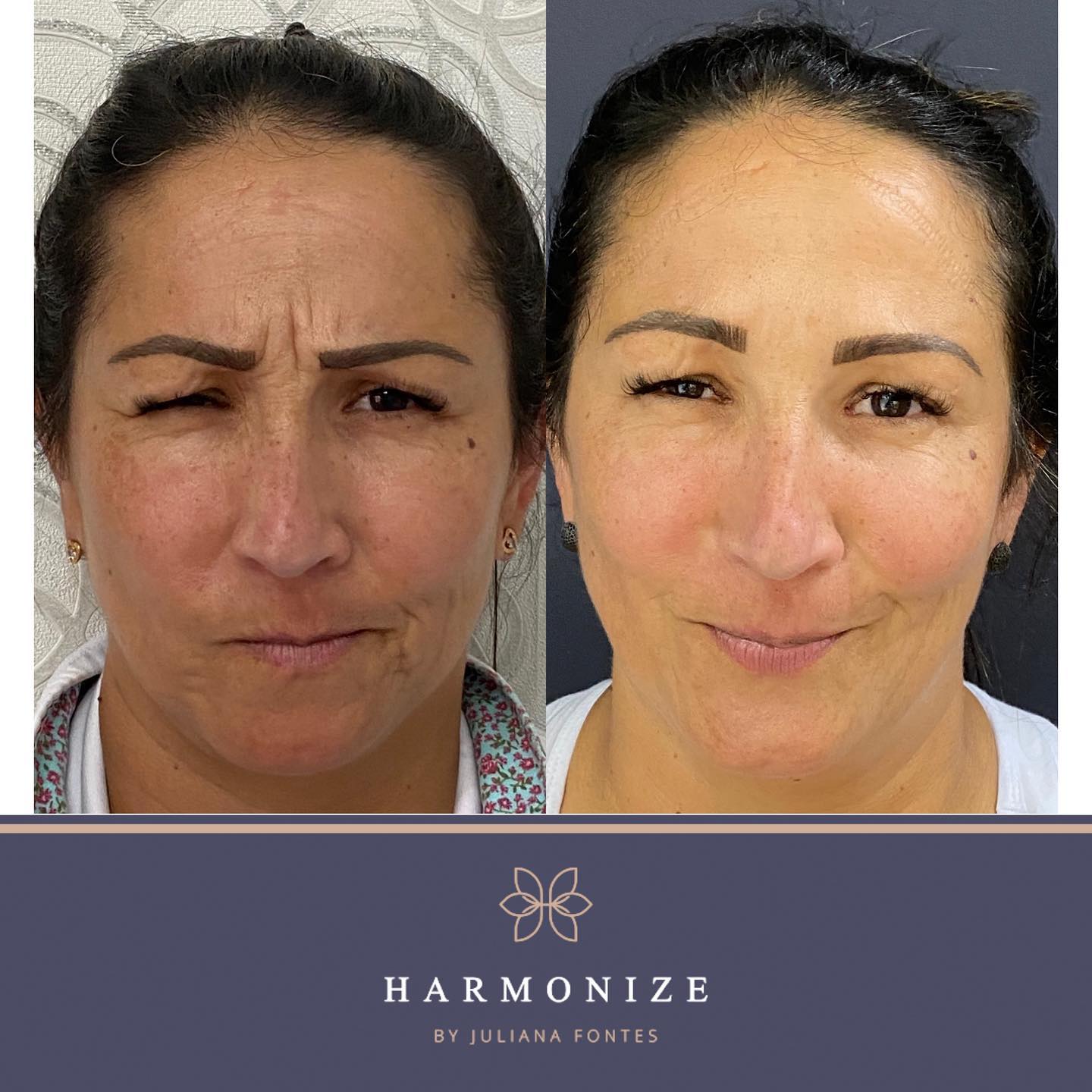 Dra. Juliana Fontes Botox #2.1