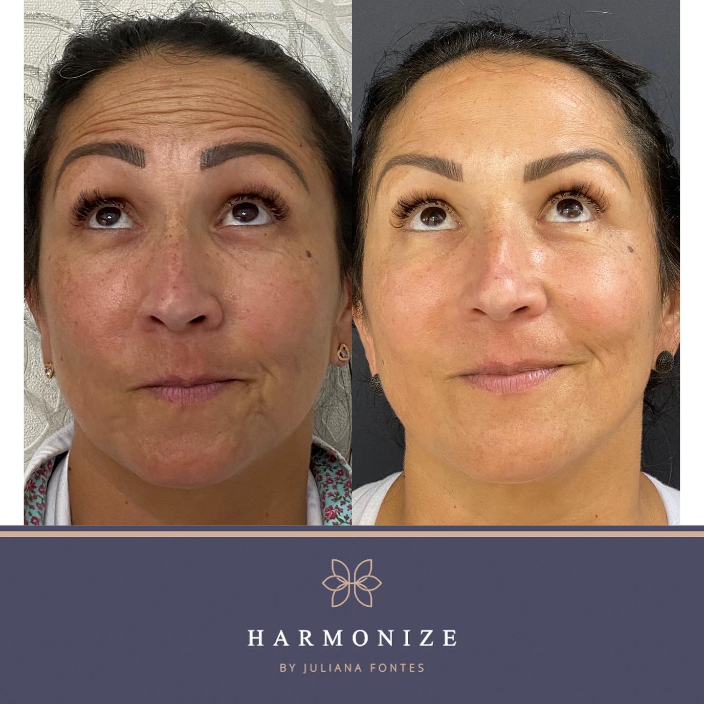 Dra. Juliana Fontes Botox #2.2