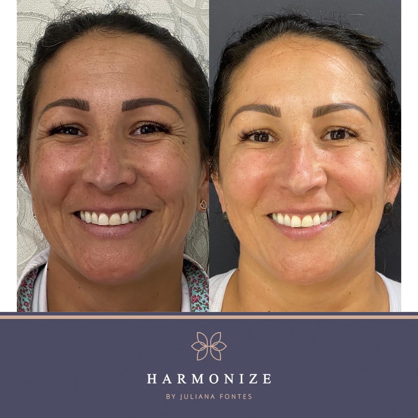 Harmonização Facial - Juliana Fontes - Agende sua avaliação