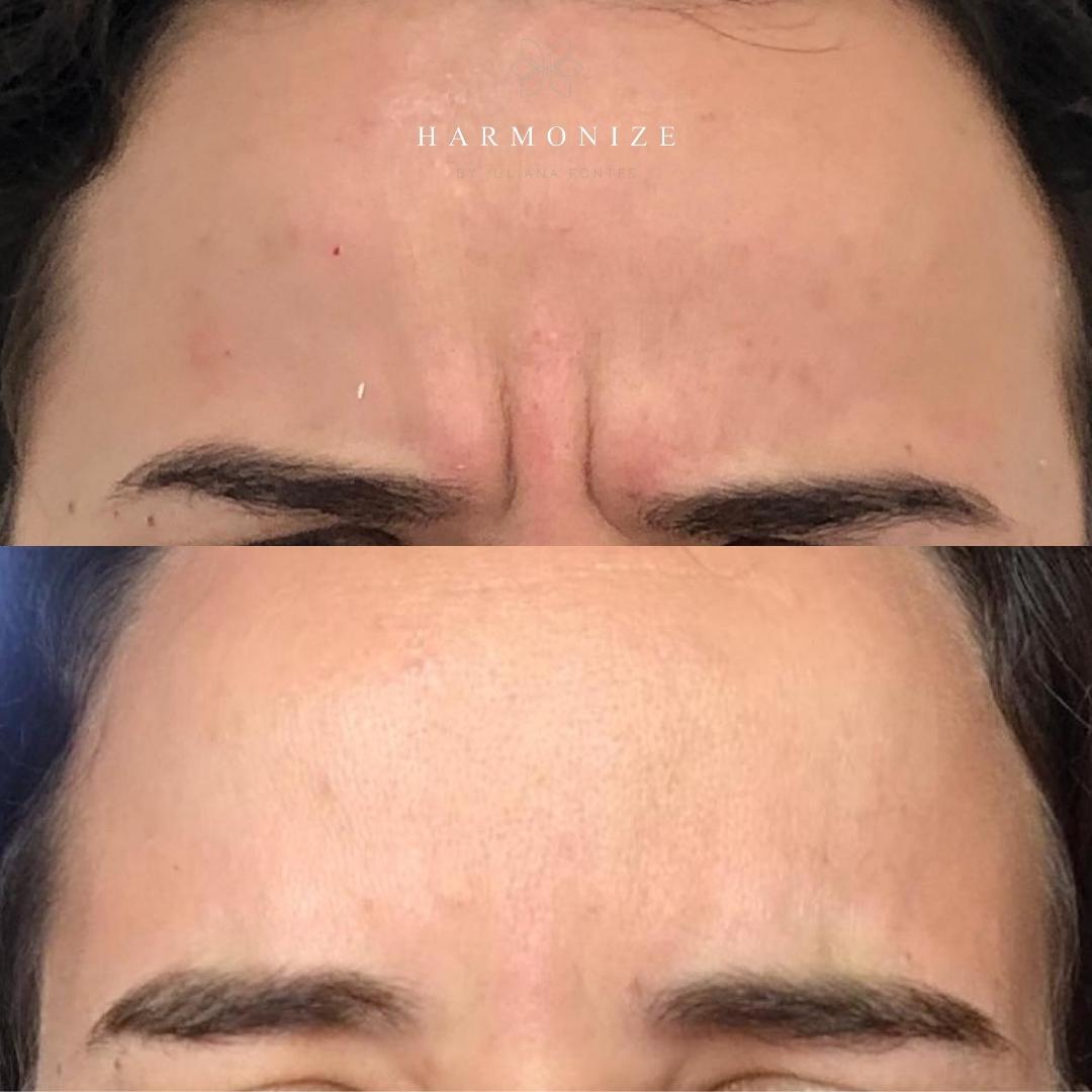 Dra. Juliana Fontes Botox #7.1.E