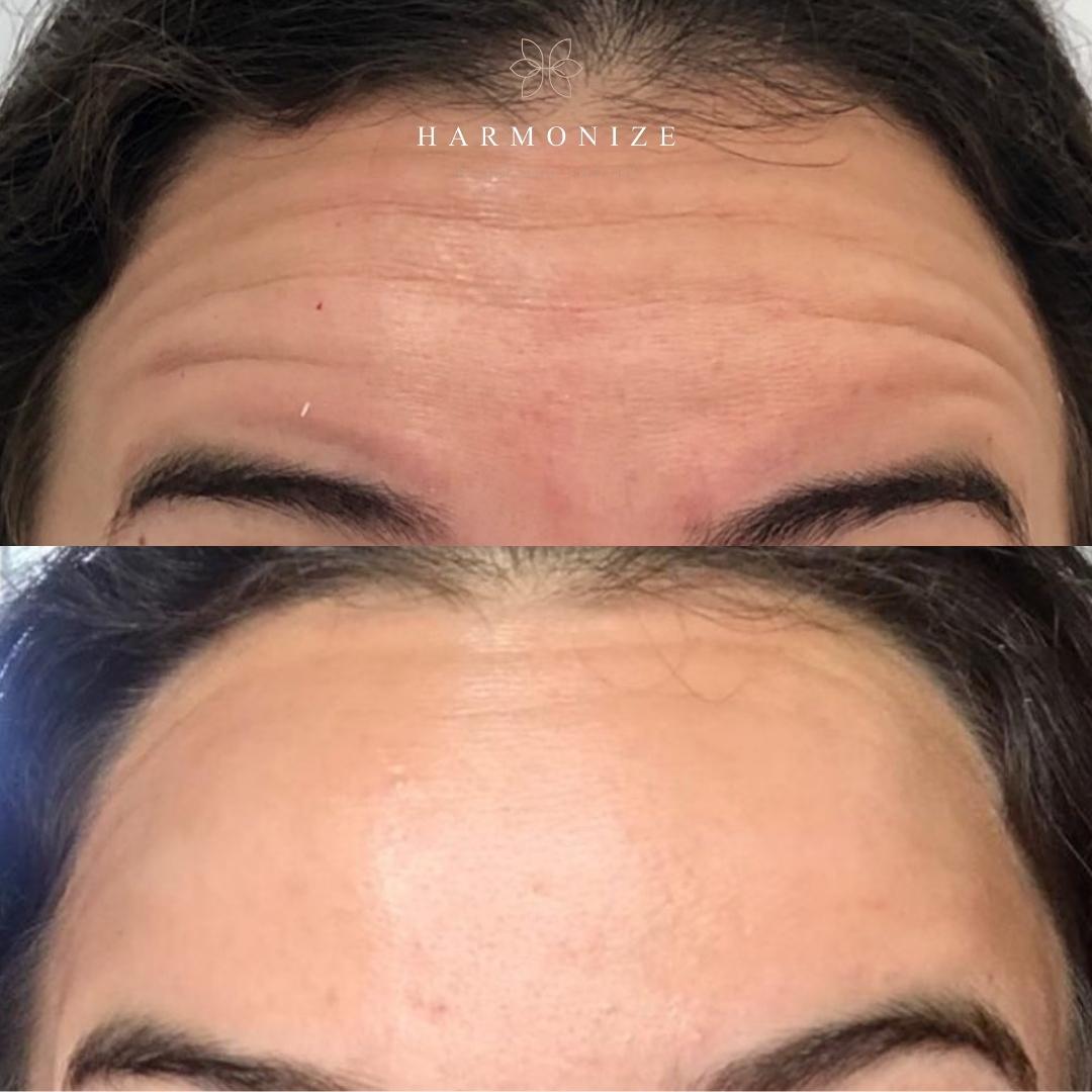 Dra. Juliana Fontes Botox #7.2.E