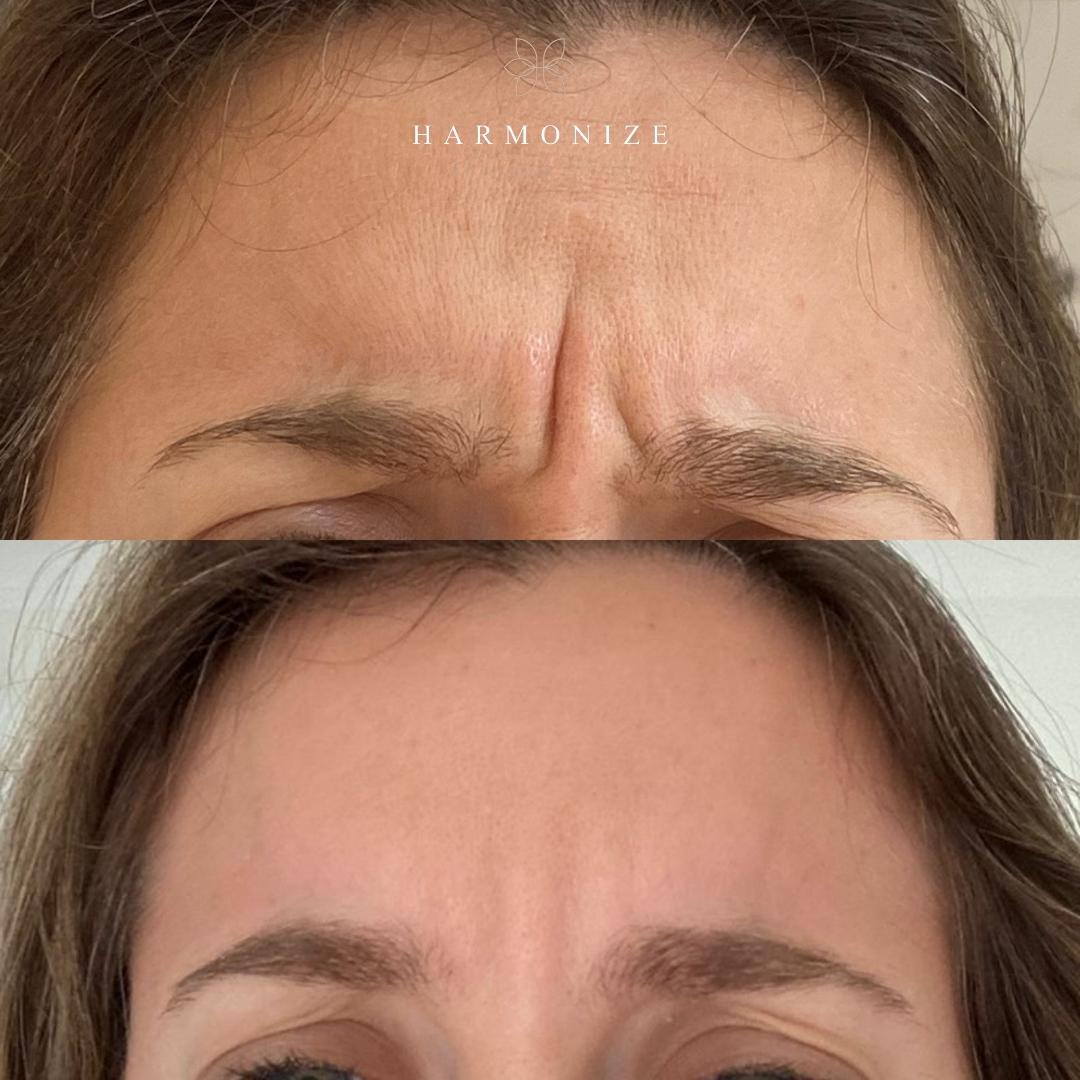 Dra. Juliana Fontes Botox #8.1.E