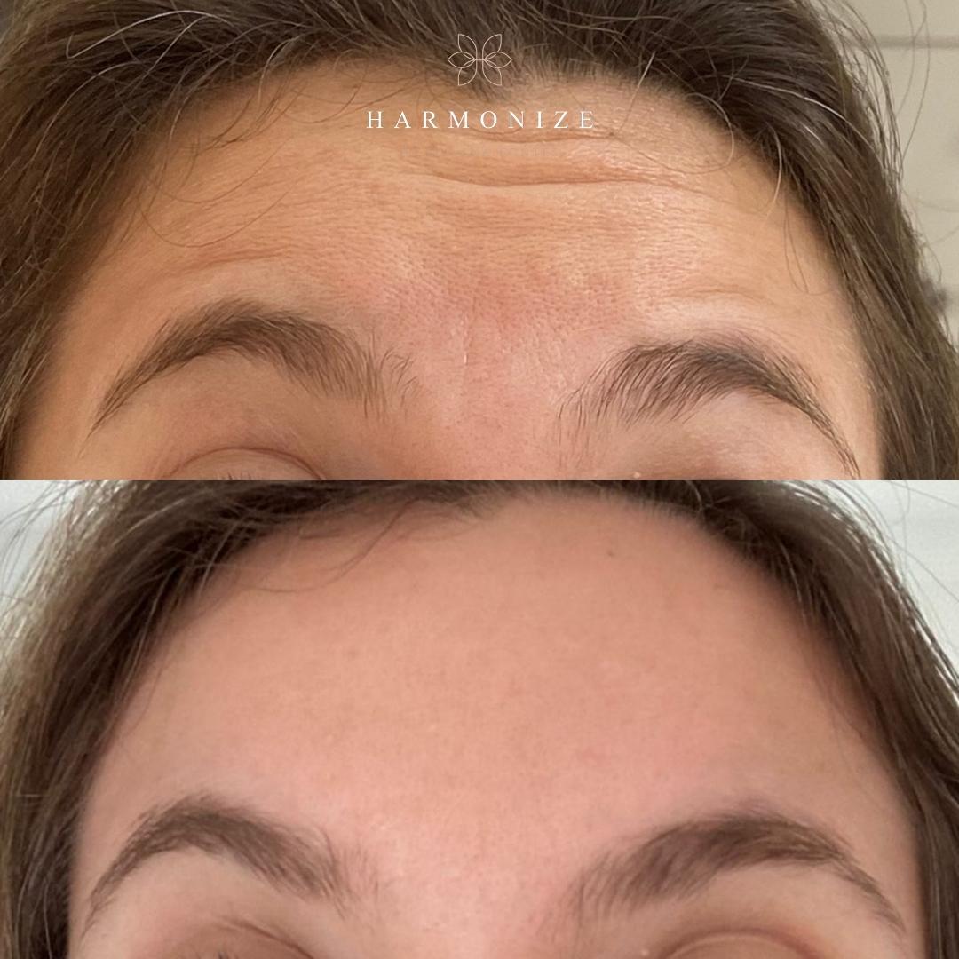 Dra. Juliana Fontes Botox #8.2.E