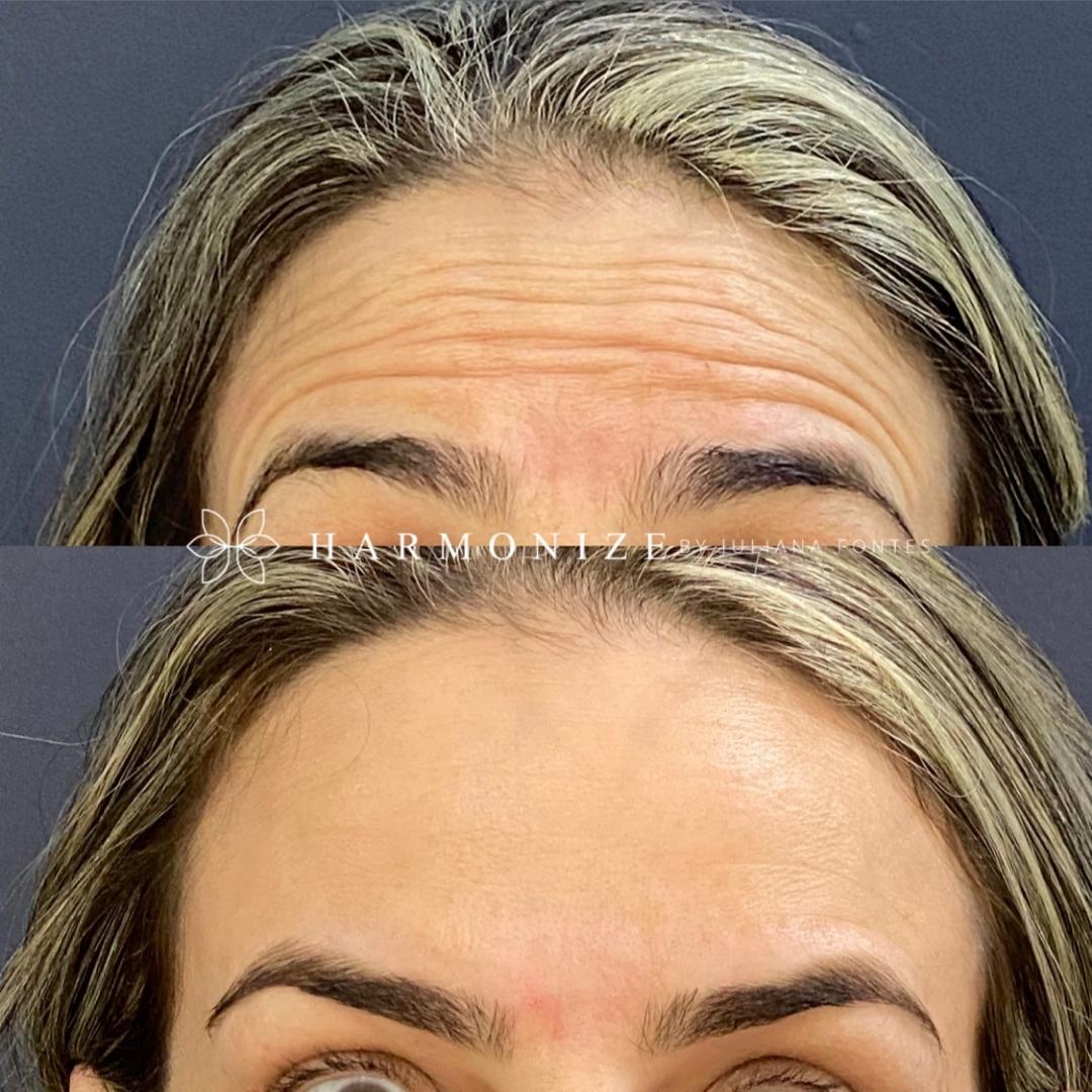 Dra. Juliana Fontes Botox #9.1.E