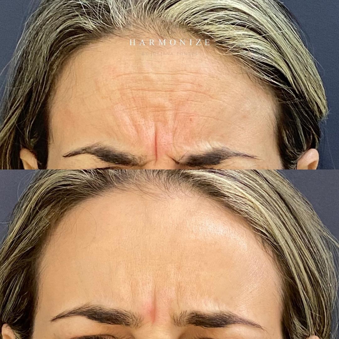 Dra. Juliana Fontes Botox #9.2.E