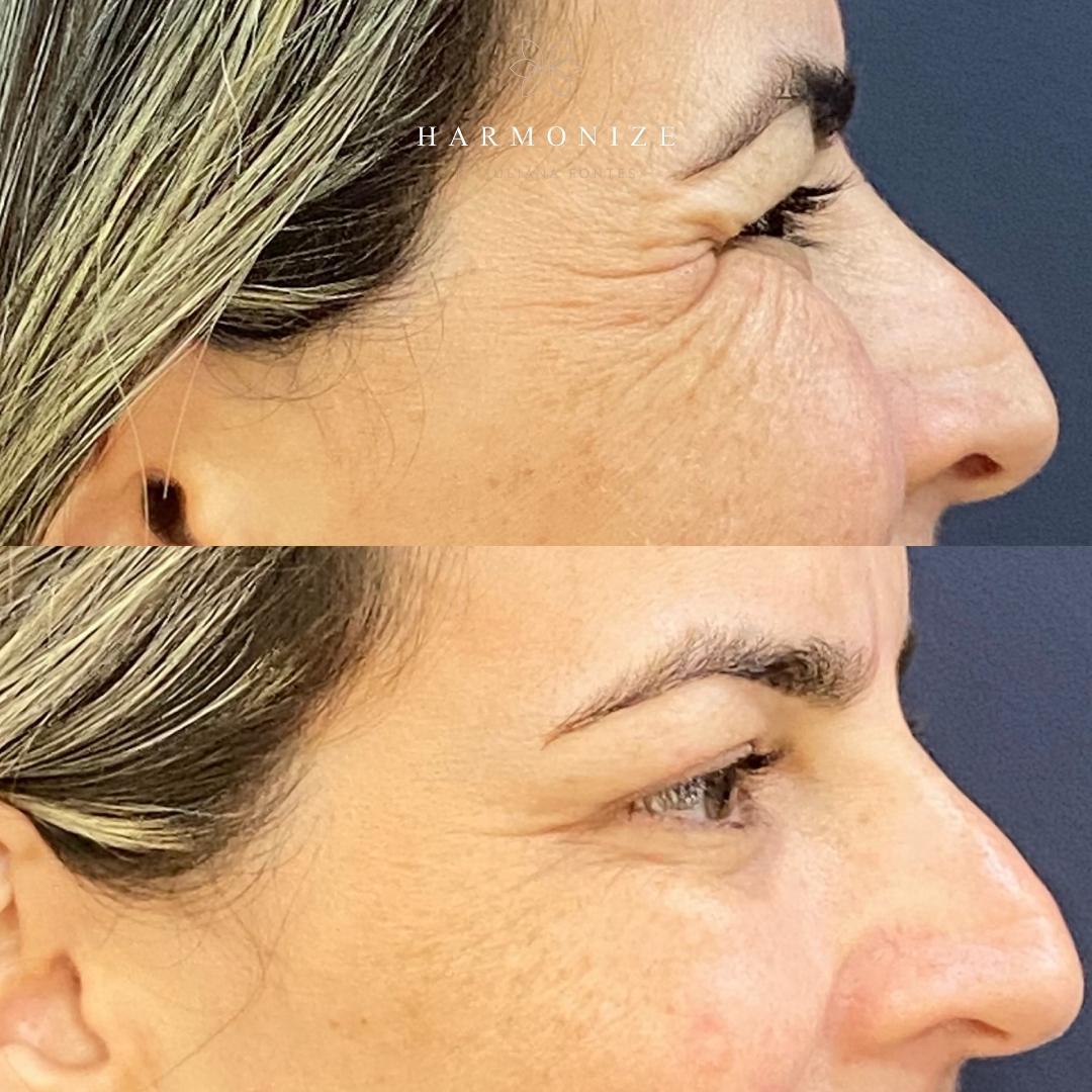 Dra. Juliana Fontes Botox #9.3.E