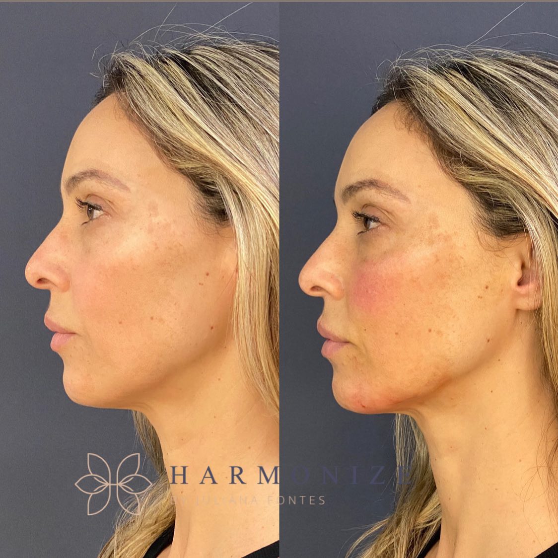 Dra. Juliana Fontes Harmonização Facial #1.1