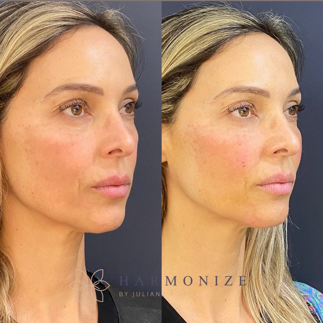 Dra. Juliana Fontes Harmonização Facial #1.3