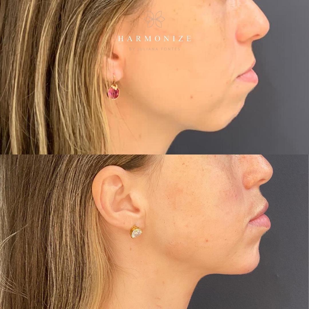 Dra. Juliana Fontes Harmonização Facial #2.2.E