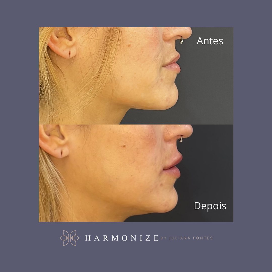 Harmonização Facial - Juliana Fontes - Agende sua avaliação