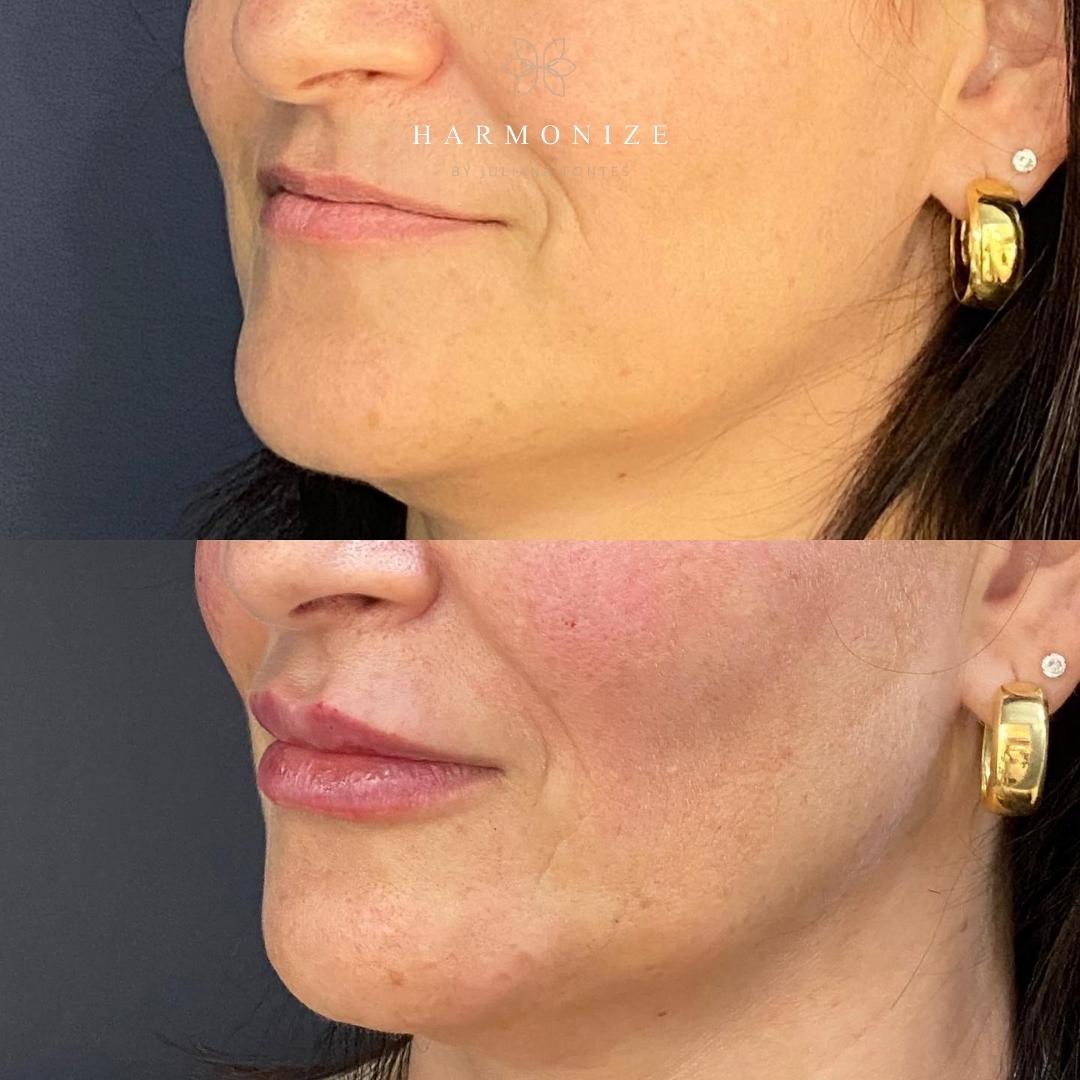 Dra. Juliana Fontes Preenchimento Labial #2.1.E