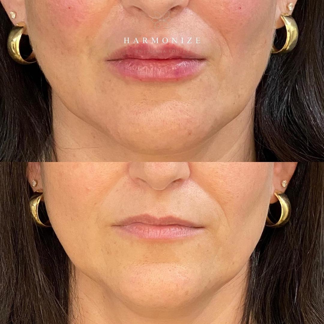 Dra. Juliana Fontes Preenchimento Labial #2.2.E
