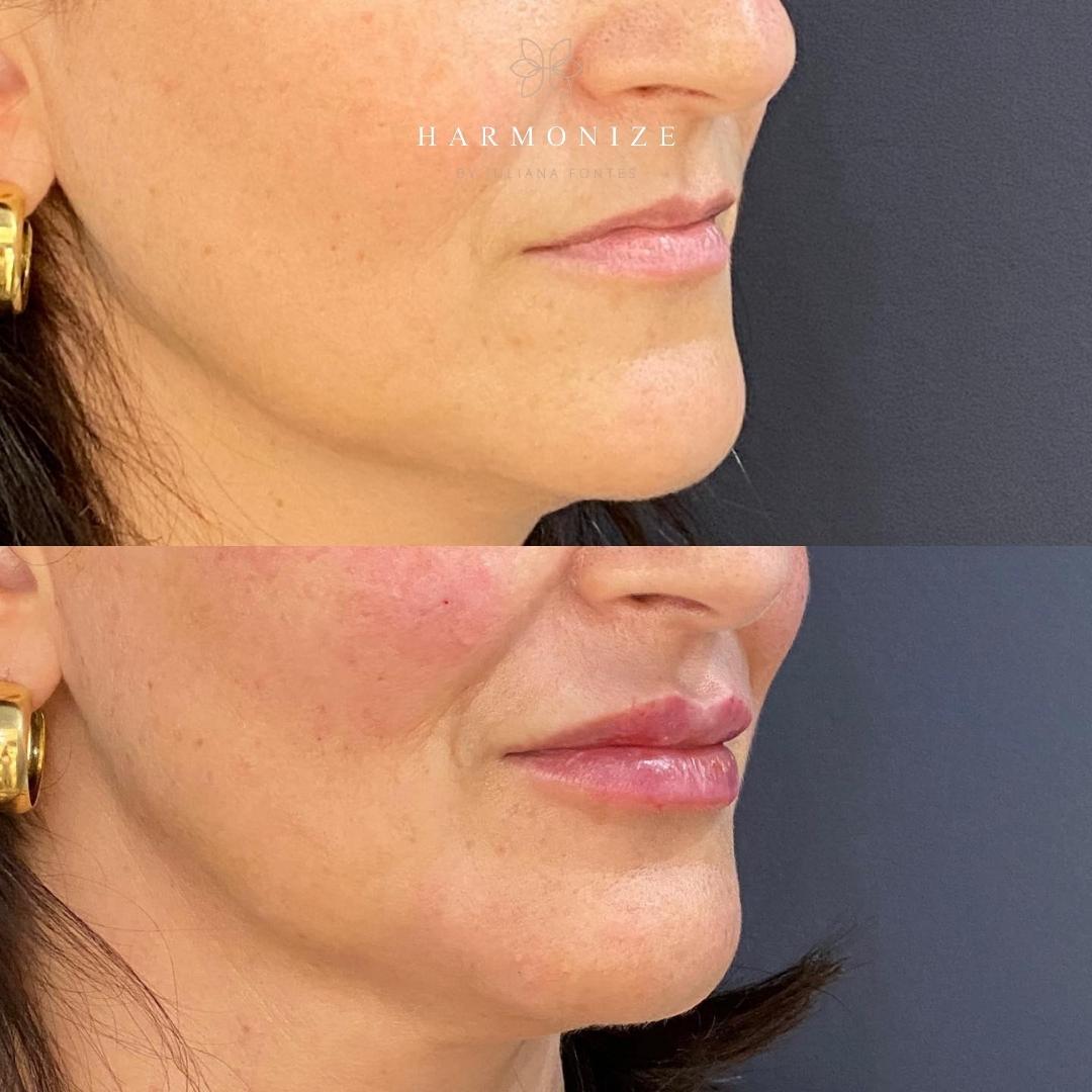 Dra. Juliana Fontes Preenchimento Labial #2.3.E